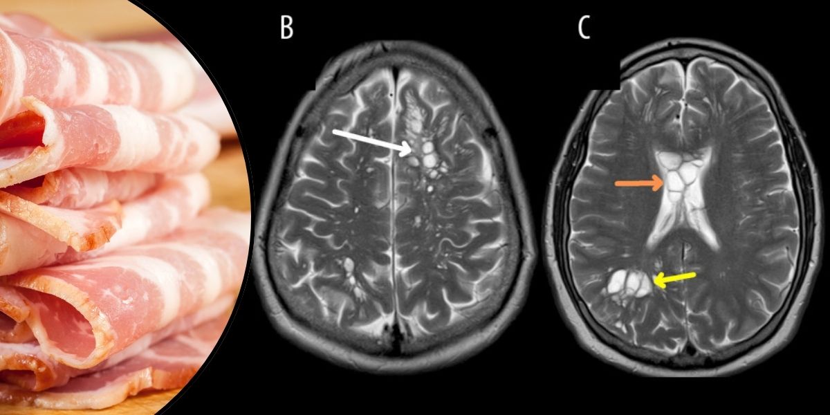 Bir adamın pişmemiş domuz pastırmasına olan sevgisi beyinde bulunan tenyalarla bağlantılıdır